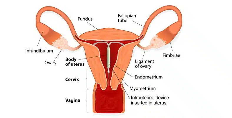 Mirena, IUD, Mirena insertion, contraception, gynaecologist Brisbane, gyanecologist Gold Coast, Mirena after baby, birth control, painful periods, 